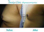 Looking for Gynecomastia Surgery Breast Treatments Delhi