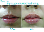 Lip Reshaping Cosmetic Surgery, Lip Reduction Clinic, Best lip surgeon in Delhi