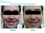 Facial/Skin Fillers Treatments for fine lines, wrinkles in New Delhi