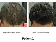 QR 678 Hair Growth Treatment - Dermatologistmumbai.com