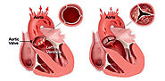 Transcatheter Aortic Valve Replacement (TAVR) in India | Fortis Escorts Hospital