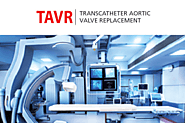 A Guide for Transcatheter Aortic Valve Replacement Procedure