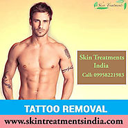 Laser Tattoo Removal Clinic in South Delhi