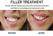 Best way to improve the attractiveness of your mouth and reduce your gummy smile