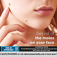Best Mole Removal Treatment by Dr Kashyap Clinic in Delhi