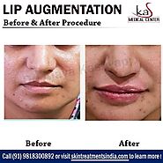 Lip Augmentation Procedure by Dr Ajaya Kashyap Plastic Surgeon in Delhi