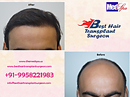 Do You Know Everything about Hair Transplant