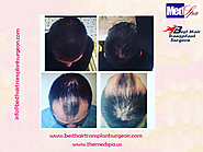 Hair transplant doctor – Choose an experienced and skilled surgeon