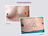 Who Can Opt For Gynecomastia Surgery? - Blad News