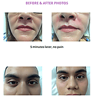 Which Dermal Filler is Perfect for your Skin? - Top Guam Clinic