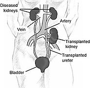 What is the Cost of Kidney Transplant in India, List of Best Kidney Transplant Hospitals in India