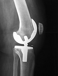 Knee Replacement Surgery in India with List of Best Knee Replacement Hospitals in India