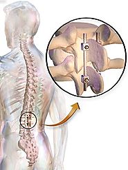 Spinal Fusion Surgery Cost in India With List of Spinal Fusion Hospitals in India