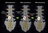 Microdiscectomy Surgery in India | Affordable Microdiscectomy Spine Surgery