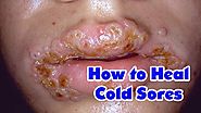 Cold Sores | How to Heal Cold Sores | How to Heal Cold Sores naturally-Healthy Wealthy