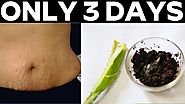 Stretch marks removal in Just 3 Days At Home
