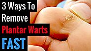 How To Get Rid Of Plantar Warts On Feet | 3 Natural Wart Remedies