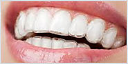 Get The Affordable Orthodontic Treatment for Teeth Straightening