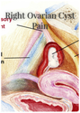 Right Ovarian Cyst Pain