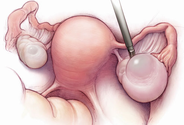 Right Ovarian Cyst Pain