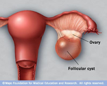 Right Ovarian Cyst Pain