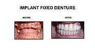 Dental Clinic In chennai | Dental Hospital In Chennai