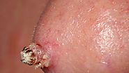 What Genital Warts Look Like: Symptoms and Removal