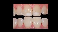 Benefits of Cosmetic Dentistry | Before & After Photos | Milford Dentists | NZ
