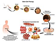 Website at http://www.stemcellcure.in/stem-cell-in-india.php#stem-cell-treatment