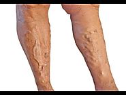 How to Get Rid of Varicose Veins Naturally