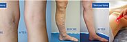 Varicose Veins Treatment in Bangalore|Varicose Veins Specialist|Motherhood