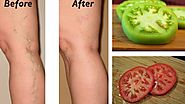 Natural Remedies for Varicose Veins using tomato