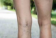 How to Get Rid of Varicose Veins Naturally