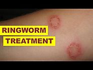 How to Get Rid of Ringworm Fast at Home - 10 Home Remedies for Ring Worm Treatment - EbestProducts