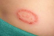 Effective Ways To Use Apple Cider Vinegar For Treating Ringworm