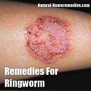 NATURAL HOME REMEDIES FOR RINGWORM