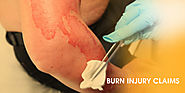 Types of Burn Injury and Claims – Seriously Injured