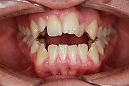 Orthodontist in Miami Explains Open Bite & Treatment