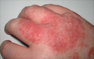 Eczema - Wikipedia, the free encyclopedia