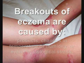 Eczema (Dermatitis)