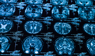 Litigating a Brain Injury Case: Overcoming the term "Mild"