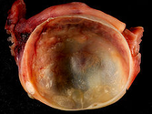 Ovarian cyst