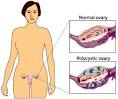 Polycystic Ovarian Syndrome