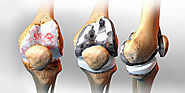 Do You Need A Knee Replacement Surgery?
