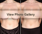 Breast Reduction