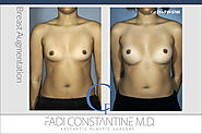 Breast Augmentation Dallas | Constantine Plastic Surgery Center