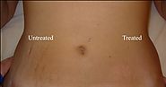How to Get Rid of Stretch Marks Naturally with THIS Oil (Massaging Tips Included) | Natural Solutions Magazine