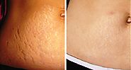 Get Rid of Stretch Marks Naturally