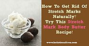 How To Get Rid Of Stretch Marks Naturally?