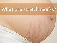 What are stretch marks? How can stretch marks be treated?